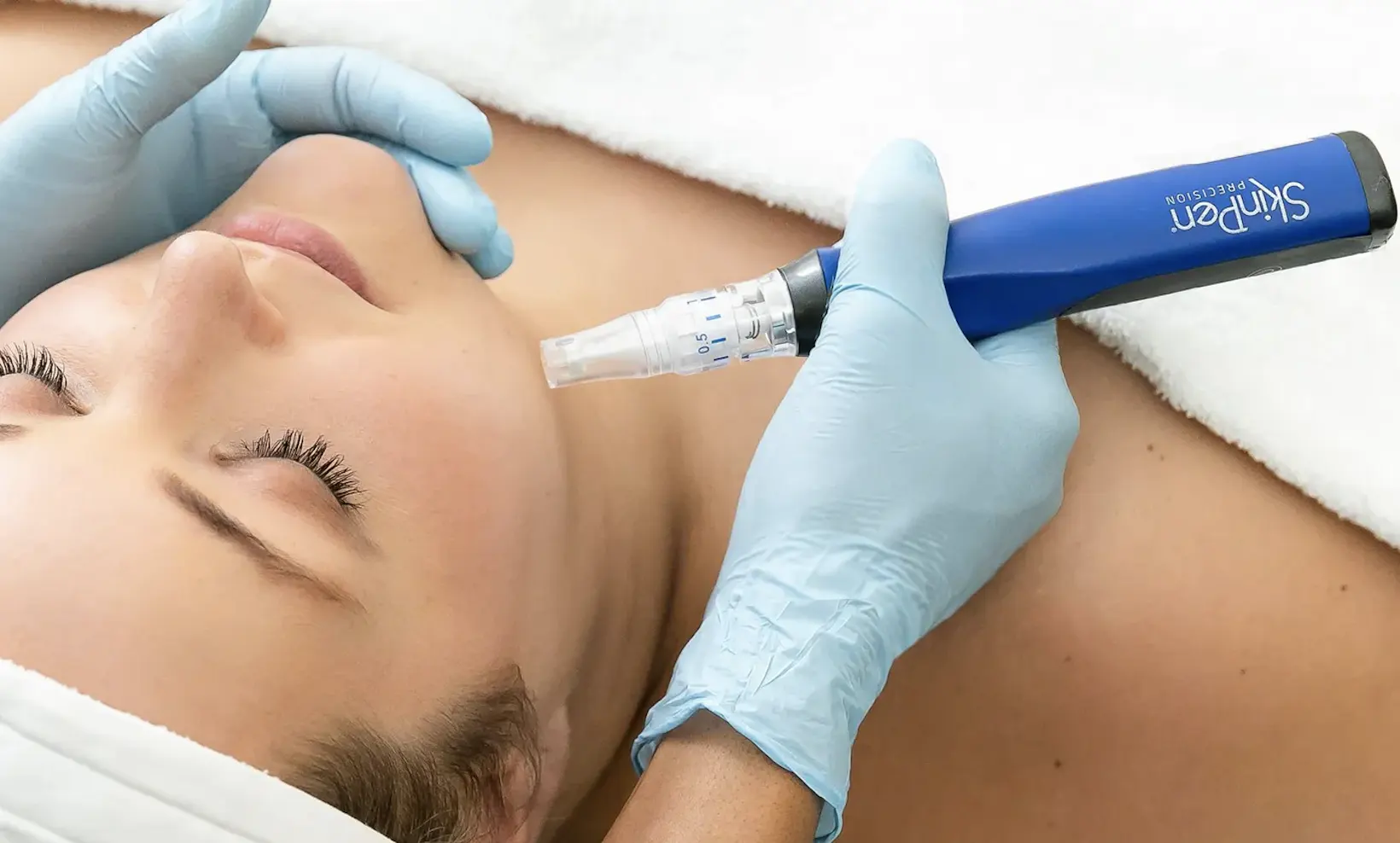 Bromley Microneedling with SkinPen