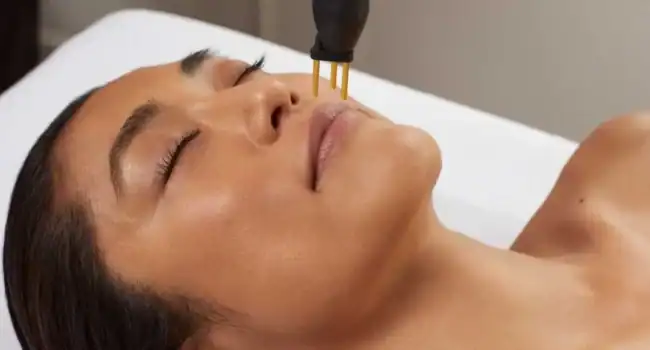 Ultimate Guide to NeoGen Plasma Skin Tightening in Bromley